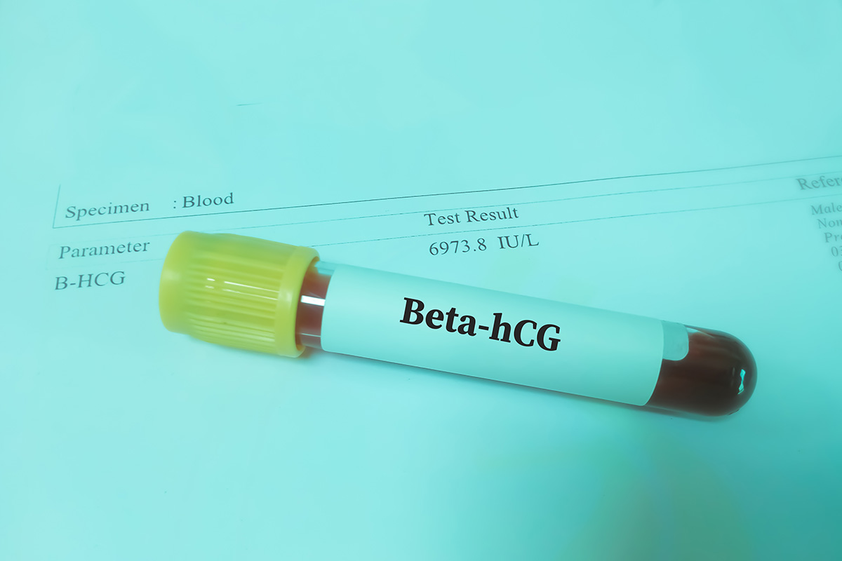 Üzerinde "Beta-hCG" yazılı, kan örneği bulunan sarı kapaklı laboratuvar tüpü ve arkasındaki test sonuç belgesi.