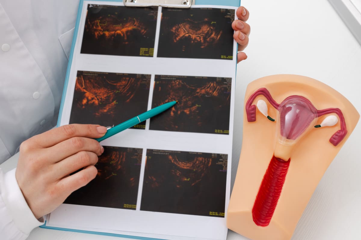 ohss belirtisi için incelenen görüntü